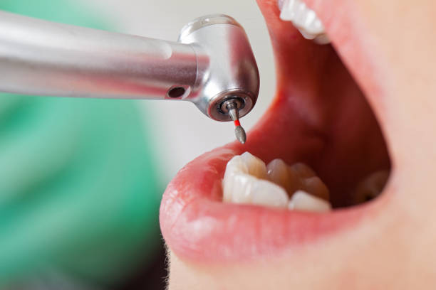 Best Emergency Tooth Extraction in Columbus, NE